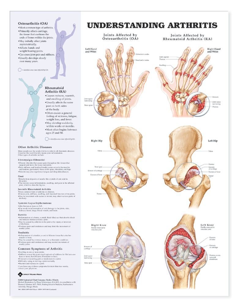 Understanding Arthritis Anatomical Chart,New