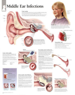 Middle Ear Infection chart: Wall Chart,Used