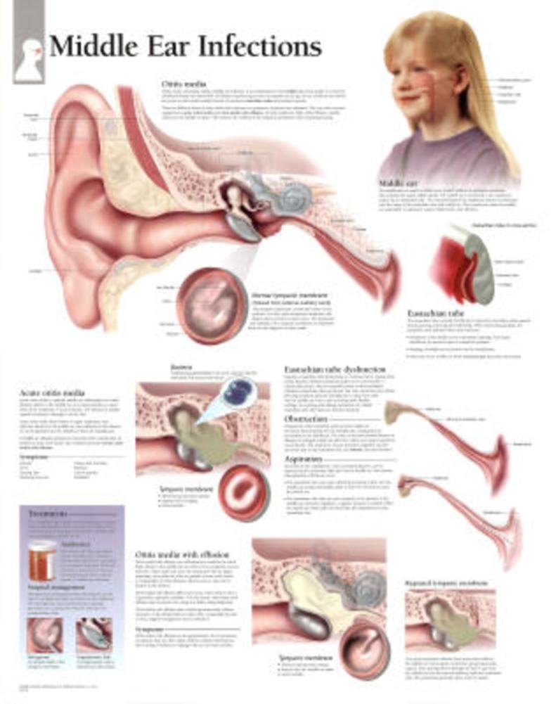 Middle Ear Infection chart: Wall Chart,Used