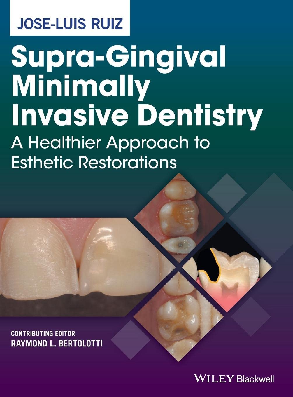 SupraGingival Minimally Invasive Dentistry: A Healthier Approach to Esthetic Restorations,Used
