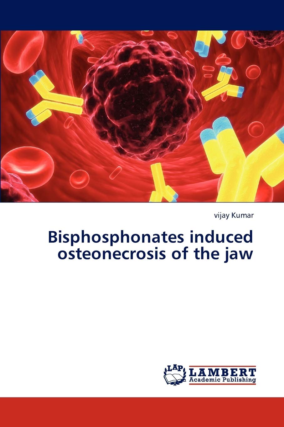 Bisphosphonates induced osteonecrosis of the jaw,Used