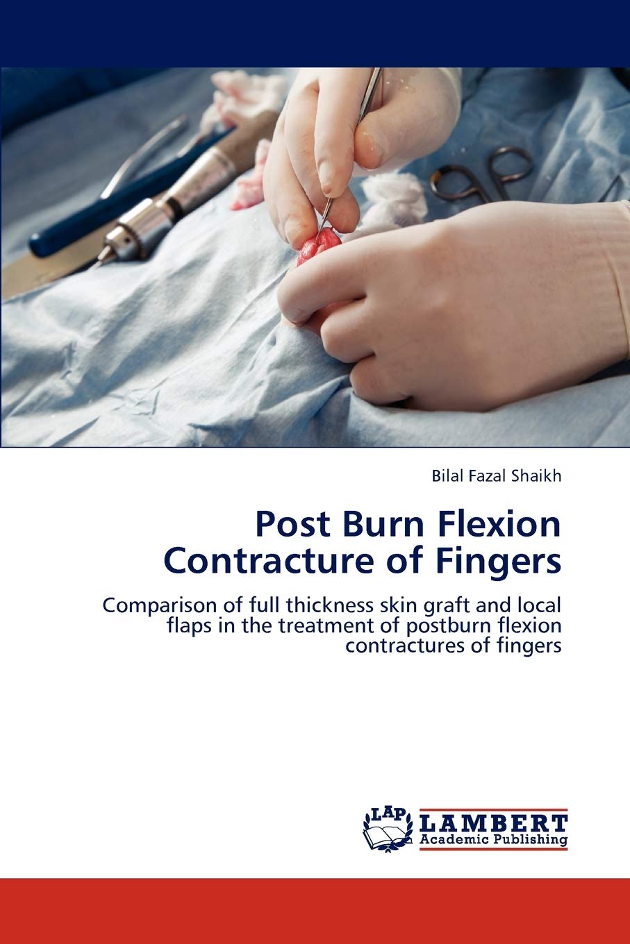 Post Burn Flexion Contracture of Fingers: Comparison of full thickness skin graft and local flaps in the treatment of postburn f,Used