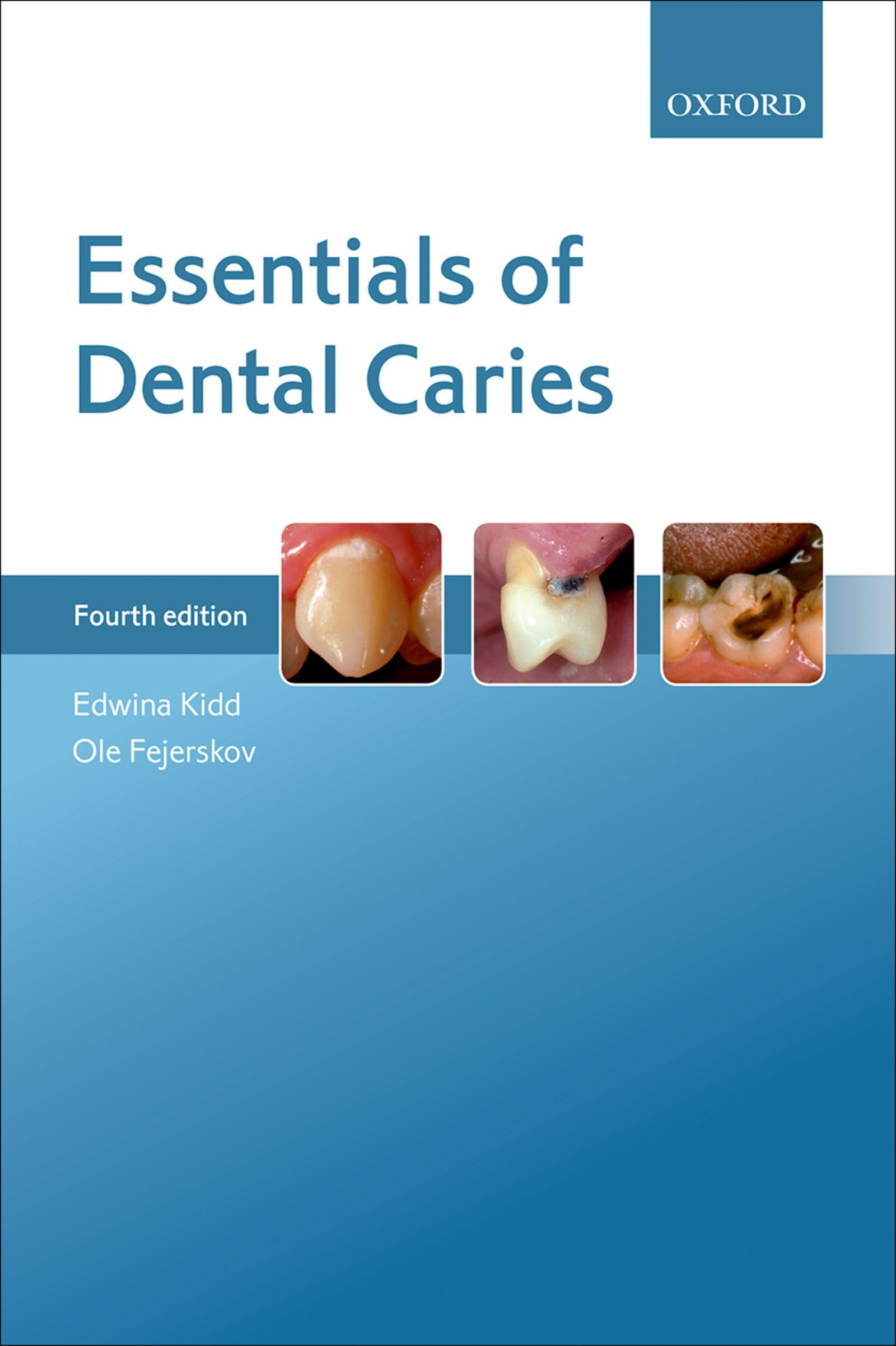 Essentials Of Dental Caries,New