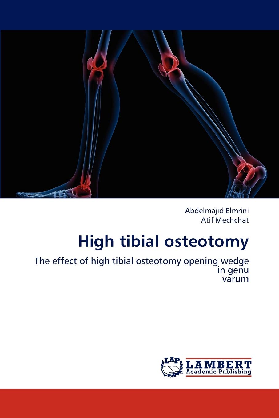 High tibial osteotomy: The effect of high tibial osteotomy opening wedge in genu varum,Used
