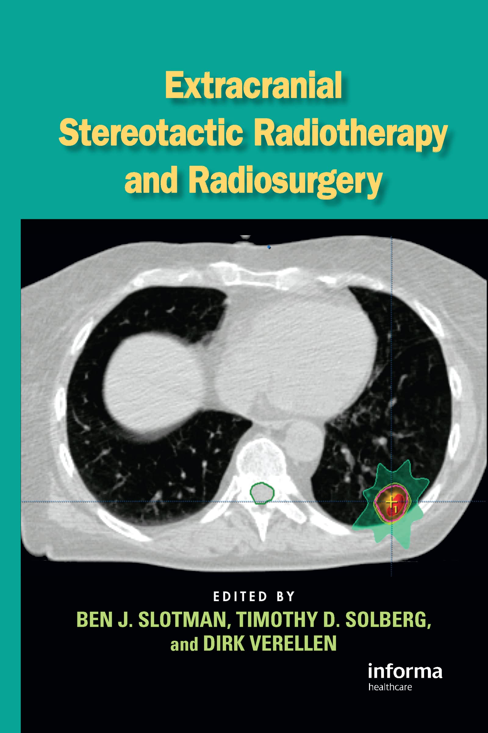 Extracranial Stereotactic Radiotherapy and Radiosurgery,Used
