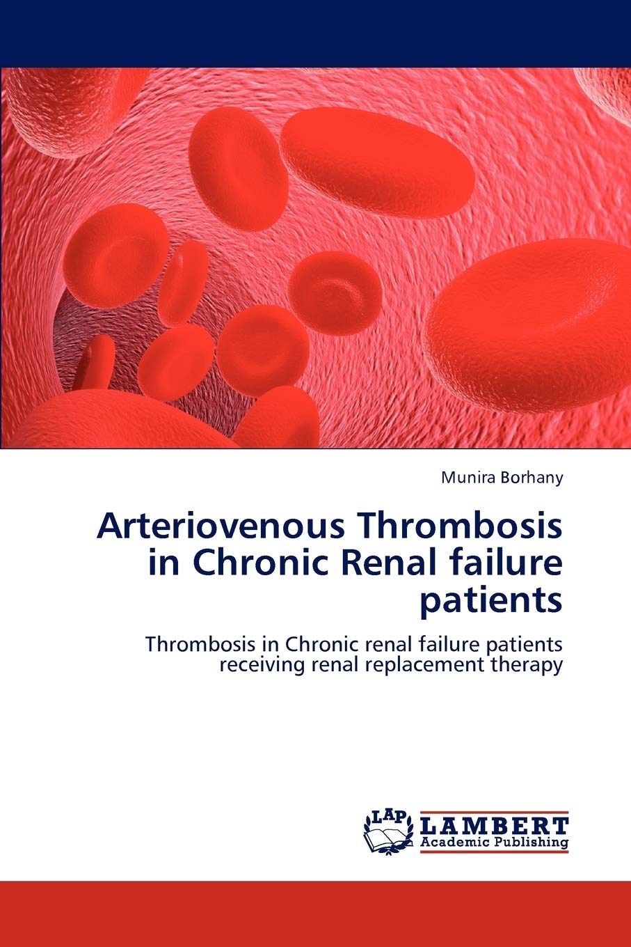 Arteriovenous Thrombosis in Chronic Renal failure patients: Thrombosis in Chronic renal failure patients receiving renal replace,Used