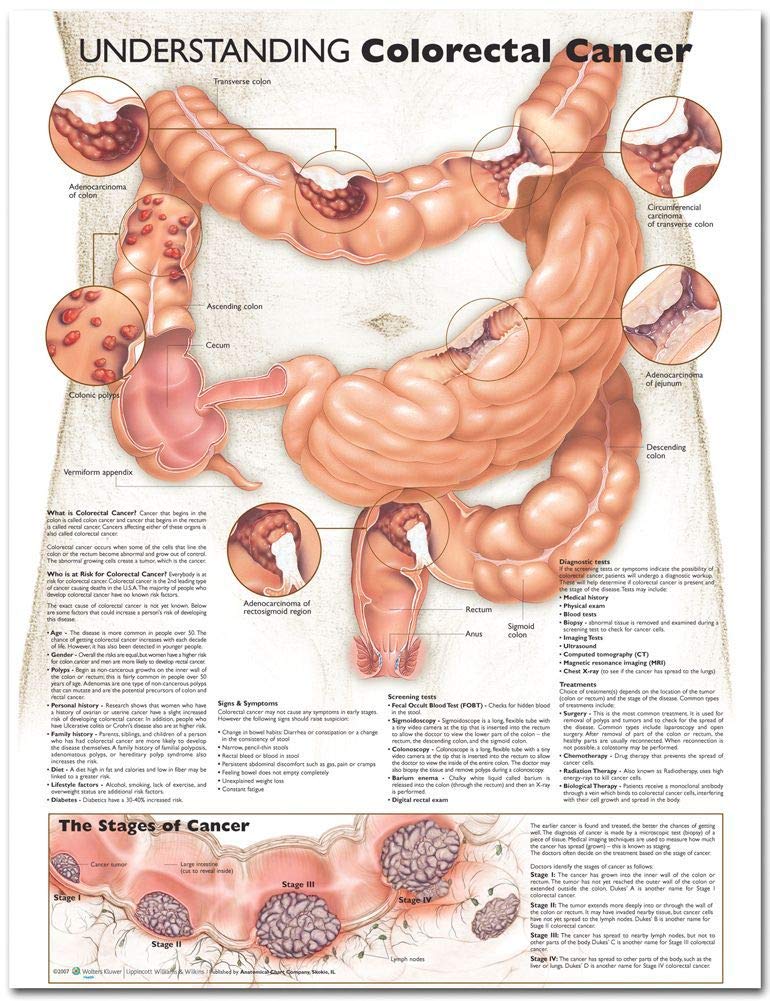 Understanding Colorectal Cancer Anatomical Chart,Used