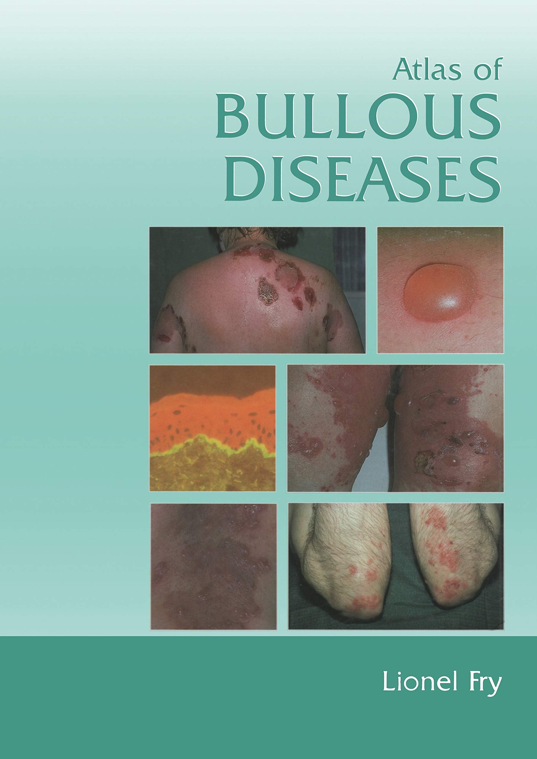 Atlas Of Bullous Diseases