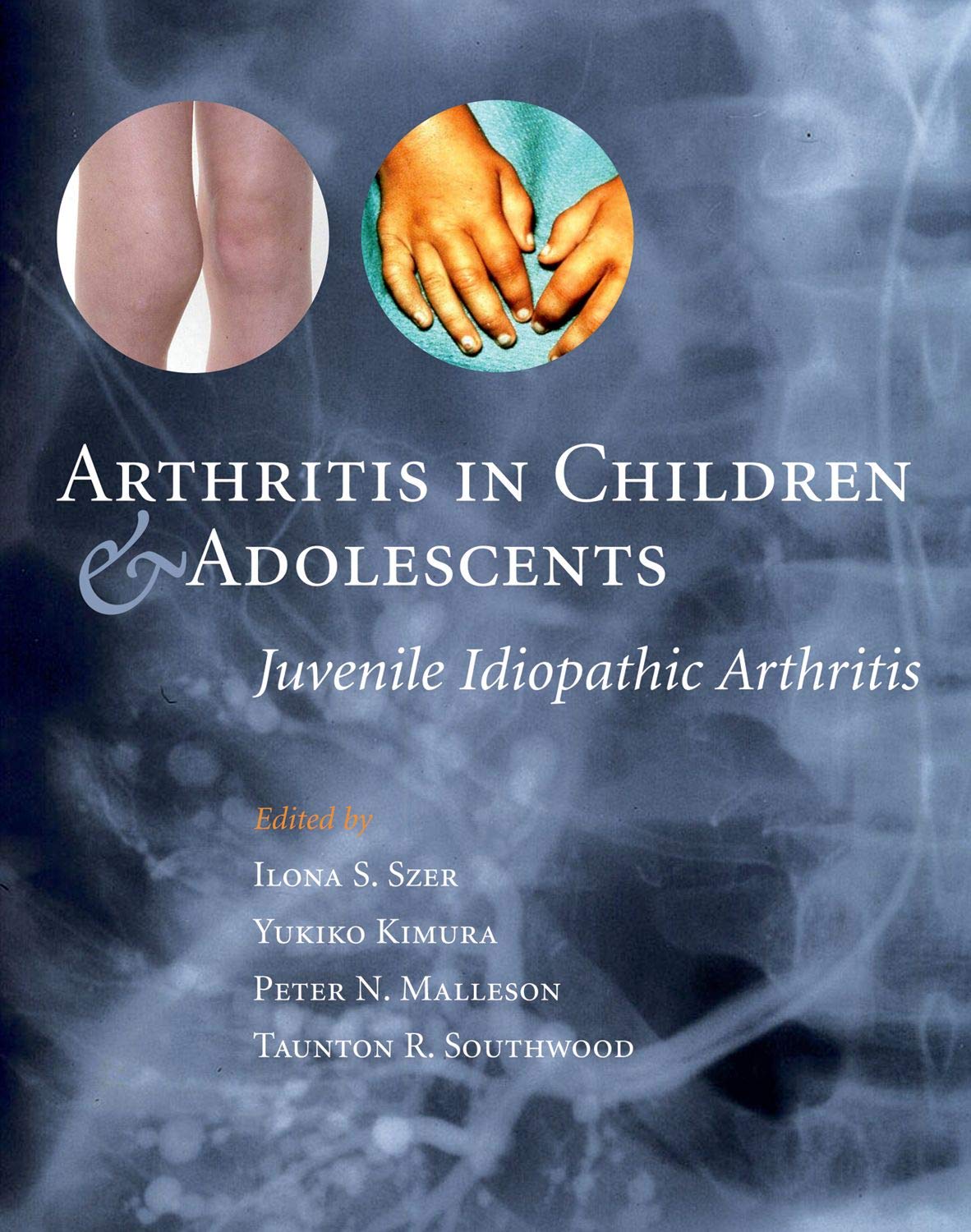 Arthritis In Children And Adolescents: Juvenile Idiopathic Arthritis