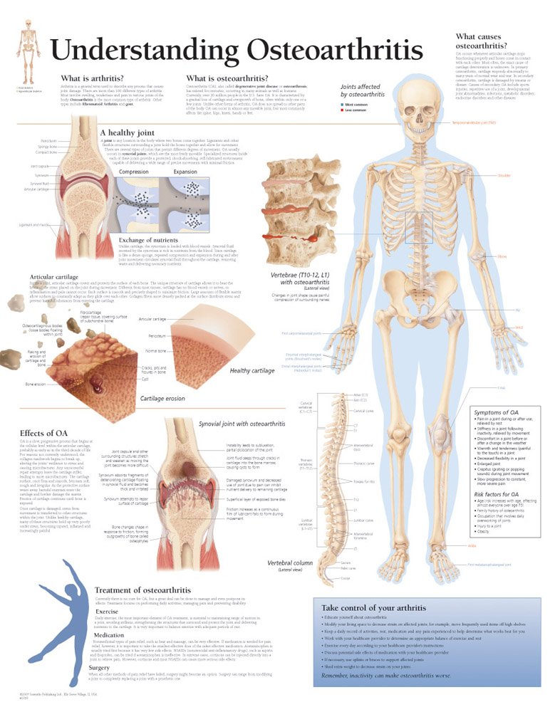 Understanding Osteoarthritis chart: Laminated Wall Chart,Used