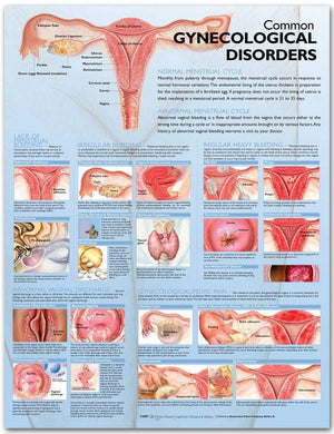 Common Gynecological Disorders Anatomical Chart,Used