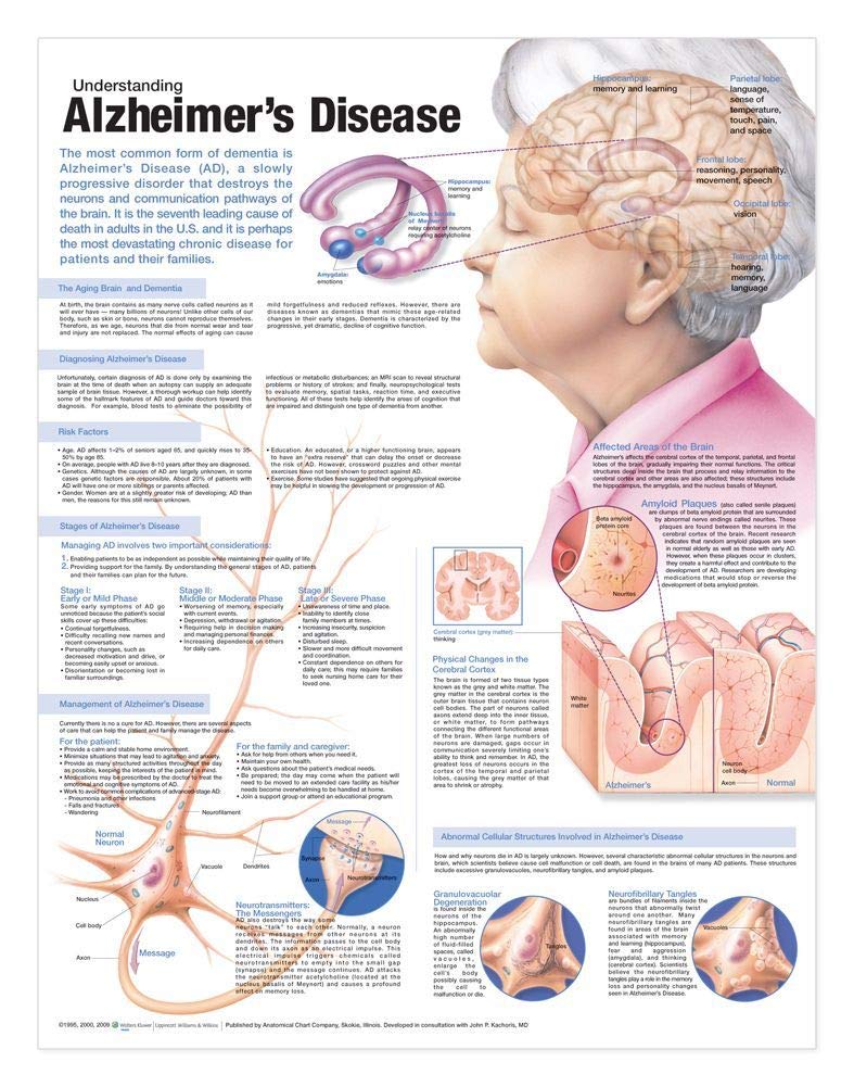 Understanding Alzheimer's Disease Anatomical Chart,Used