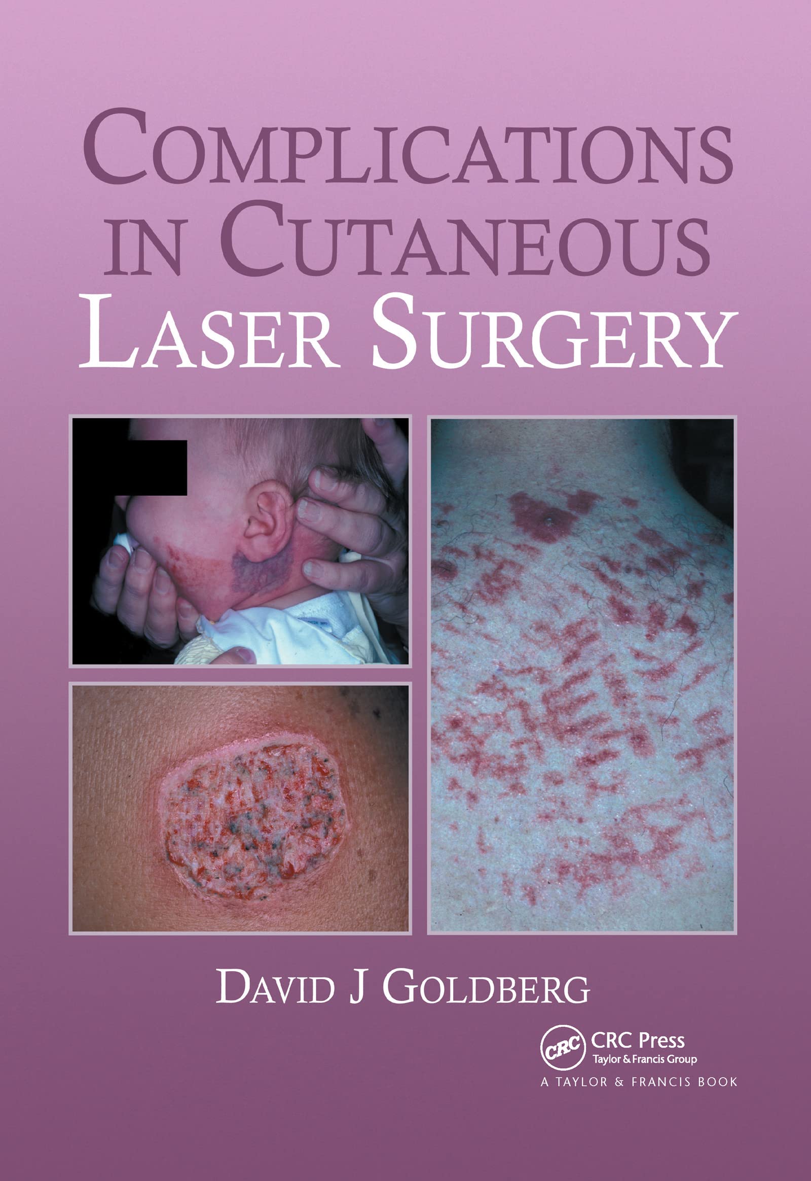 Complications in Laser Cutaneous Surgery,Used