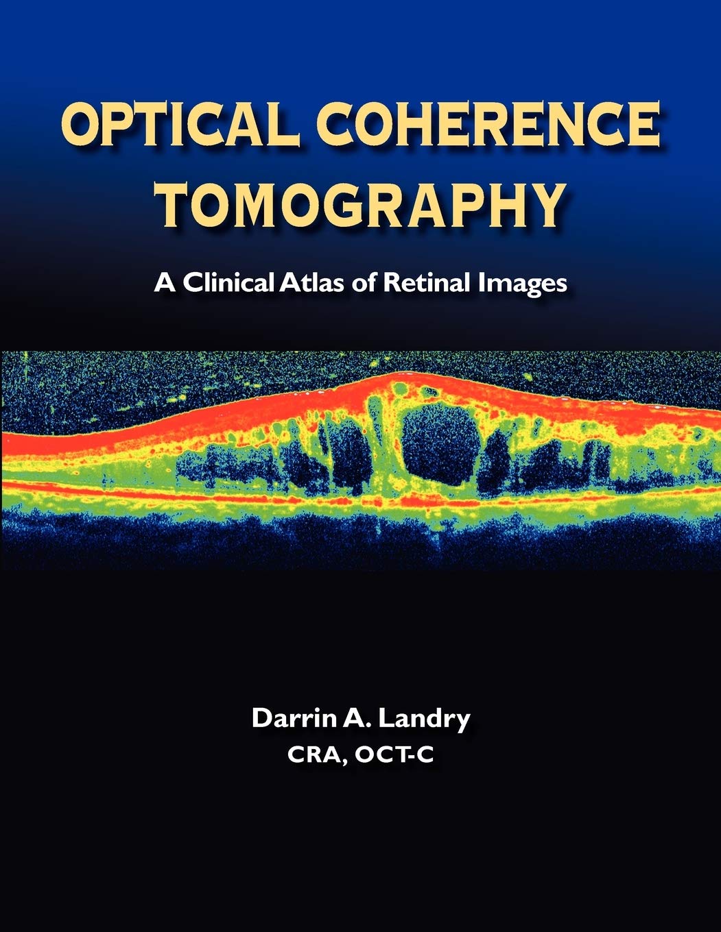 Optical Coherence Tomography: A Clinical Atlas of Retinal Images,Used