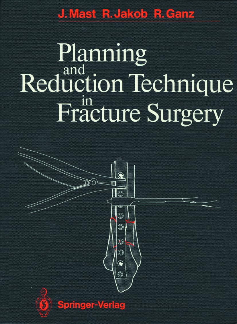 Planning and Reduction Technique in Fracture Surgery,Used