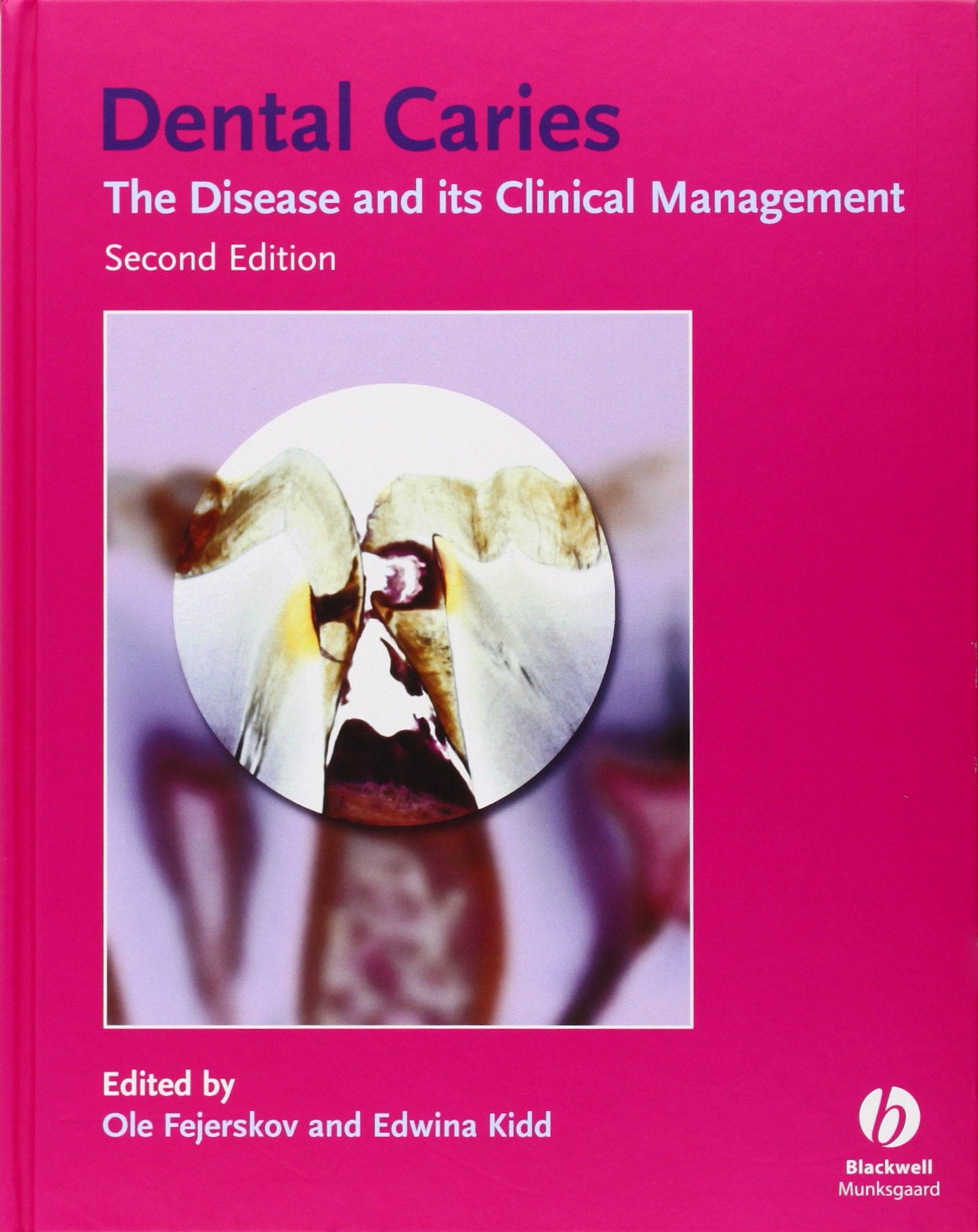 Dental Caries: The Disease and Its Clinical Management,New