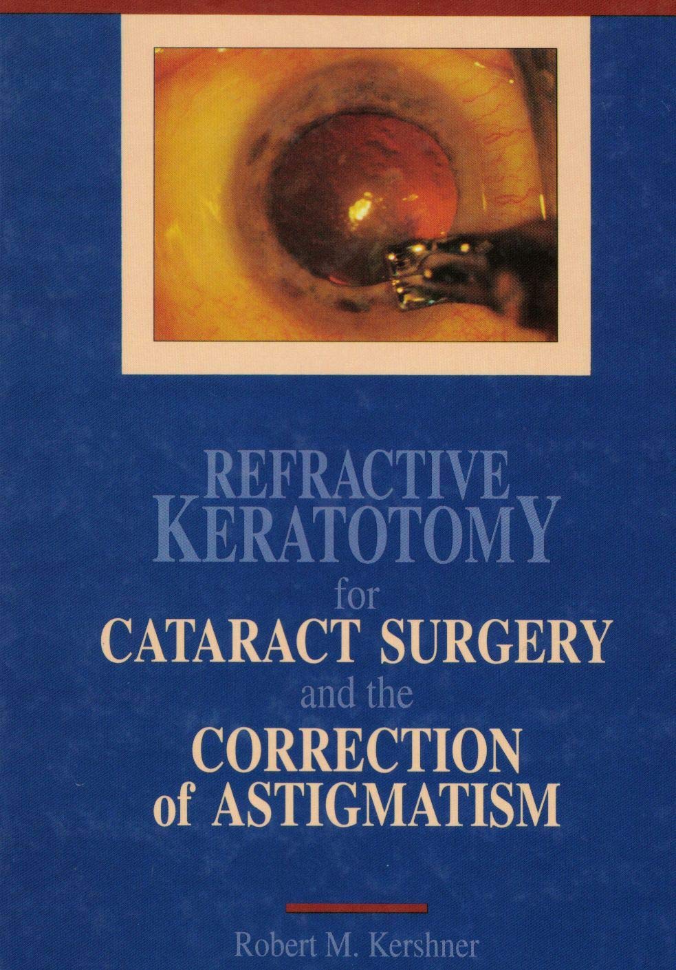 Refractive Keratotomy for Cataract Surgery and Astigmatism,Used