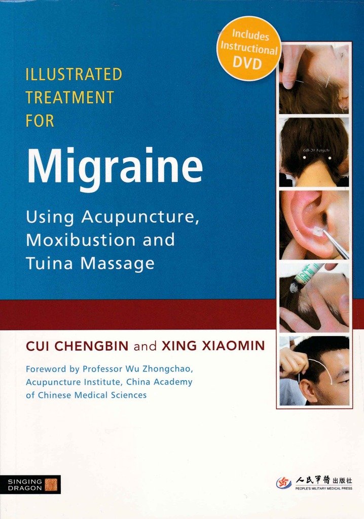 Illustrated Treatment for Migraine Using Acupuncture, Moxibustion and Tuina Massage,Used