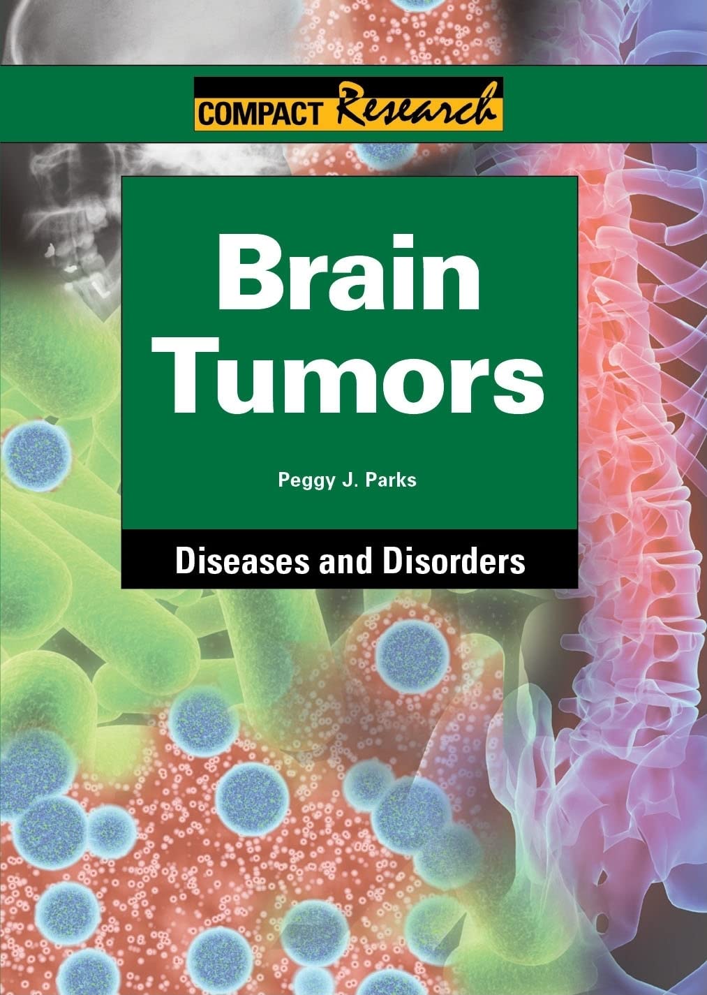 Brain Tumors (Compact Research: Diseases & Disorders),Used