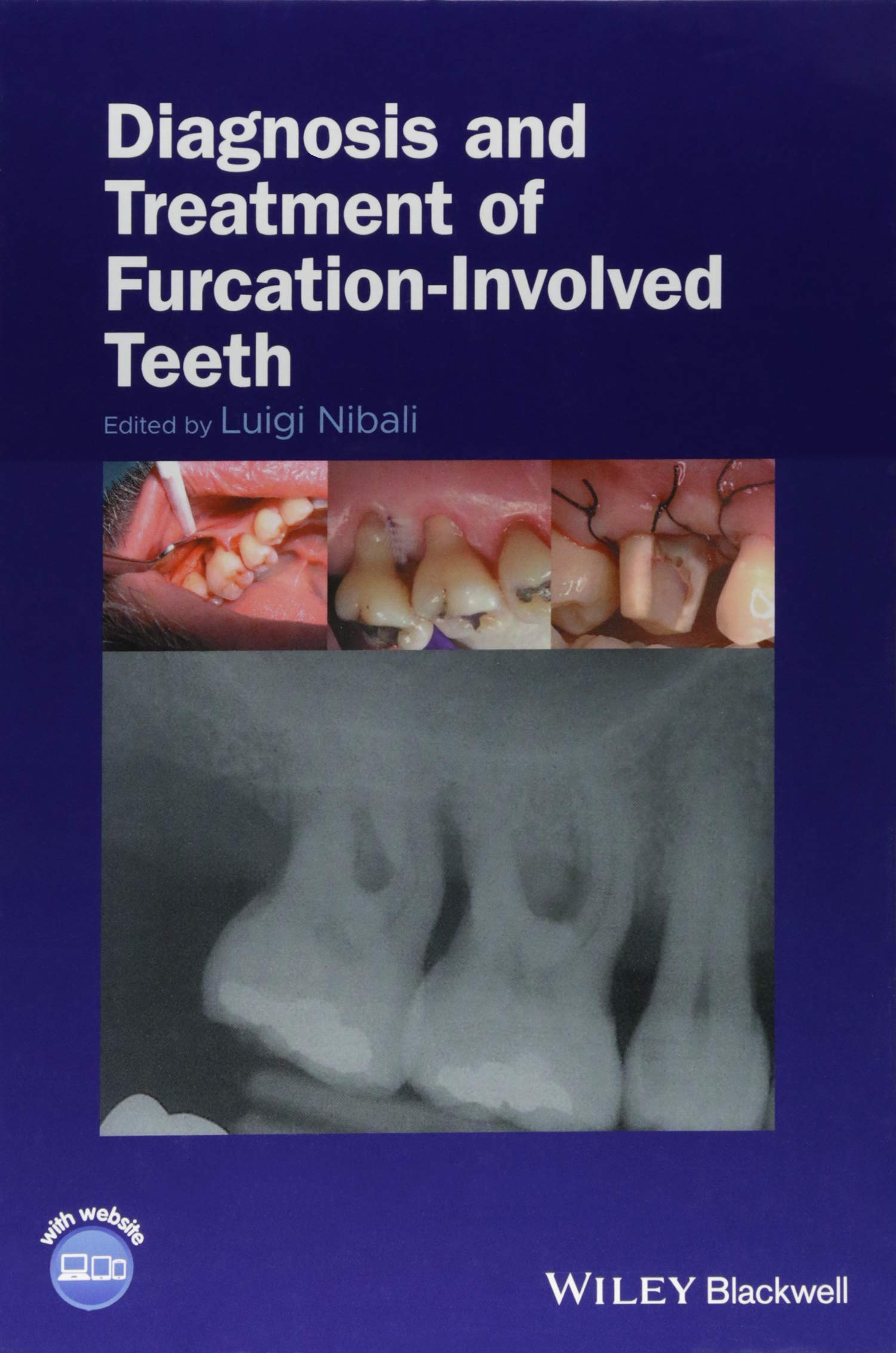 Diagnosis and Treatment of Furcationinvolved Teeth,Used