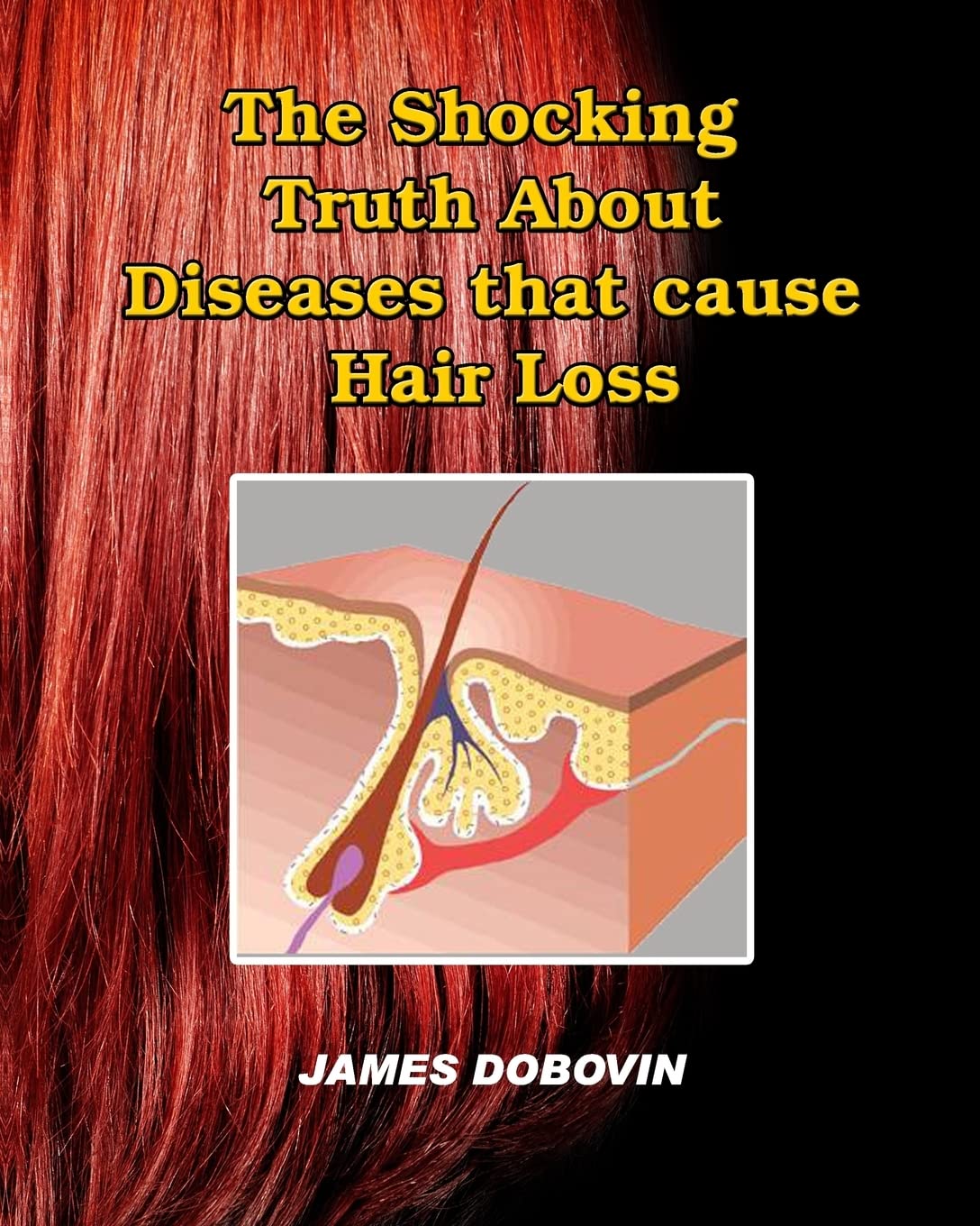 The Shocking Truth About Diseases That Cause Hair Loss: Secrets You Need To Know About Losing Hair So You Can Stop From Going Ba,Used