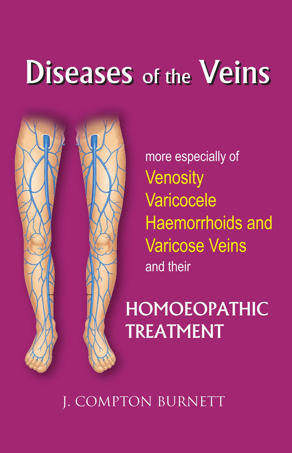 Diseases Of The Veins - More Especilly Of Venosity, Varicocele, Hemmorrhoids And Varicose Veins And Their Homoeopathic Treatment