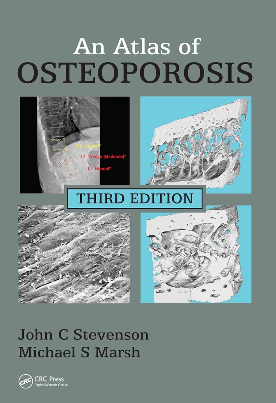 An Atlas of Osteoporosis,Used