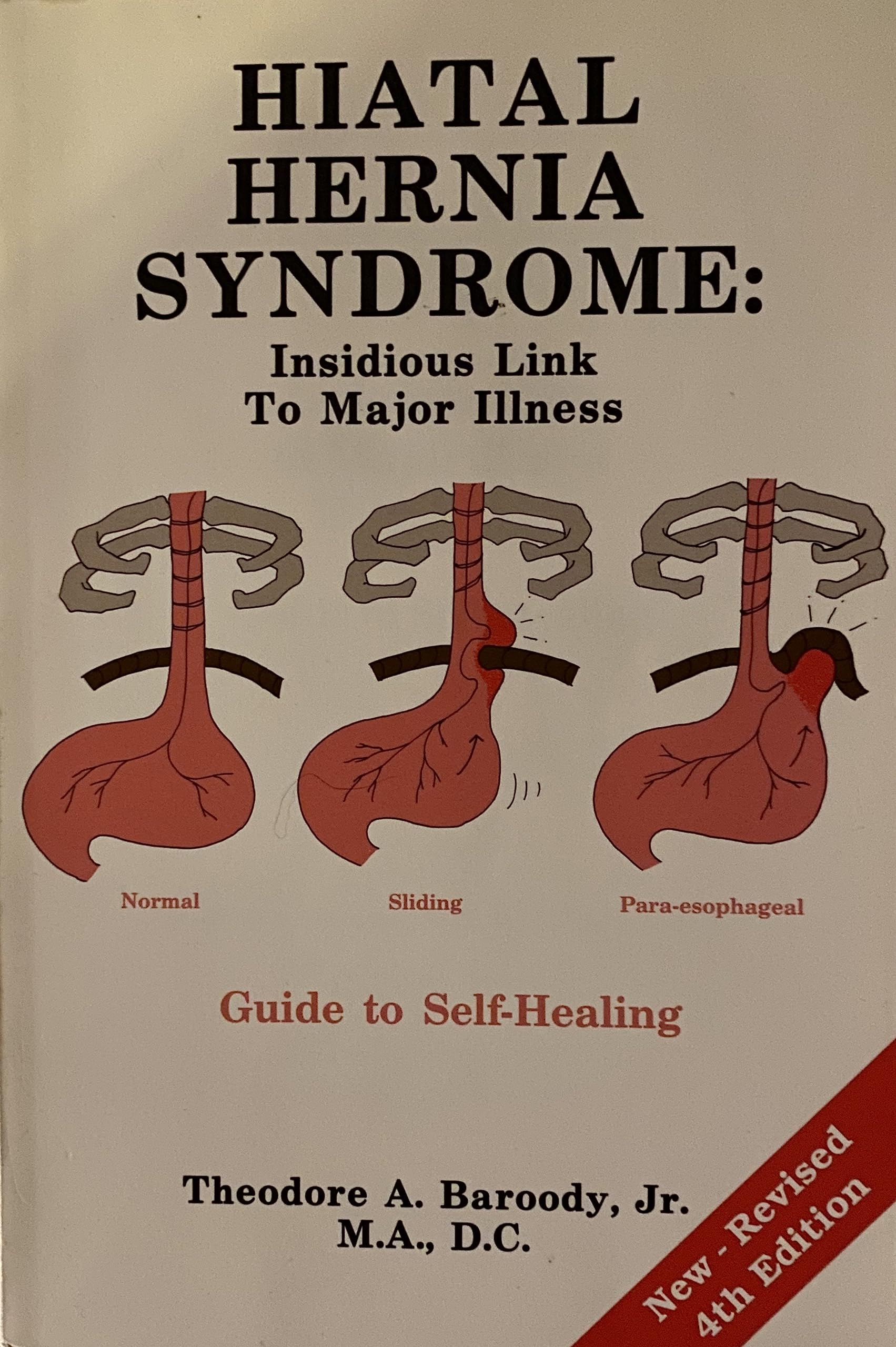 Hiatal Hernia Syndrome: Insidious Link To Major Illness Guide To Healing,New