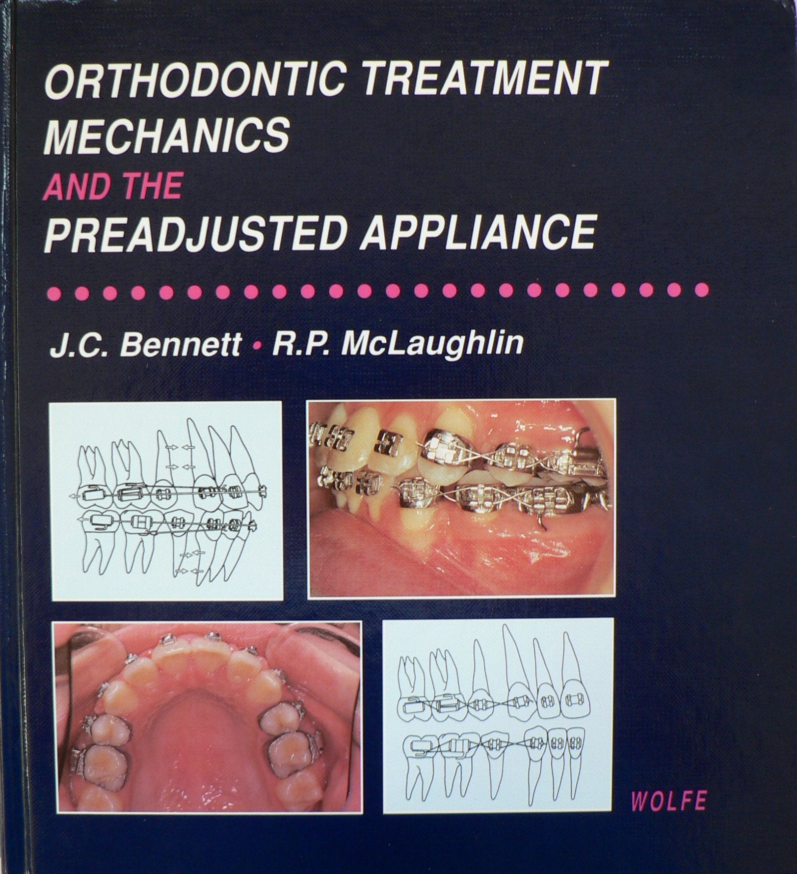 Orthodontic Treatment Mechanics and the Preadjusted Appliance,Used