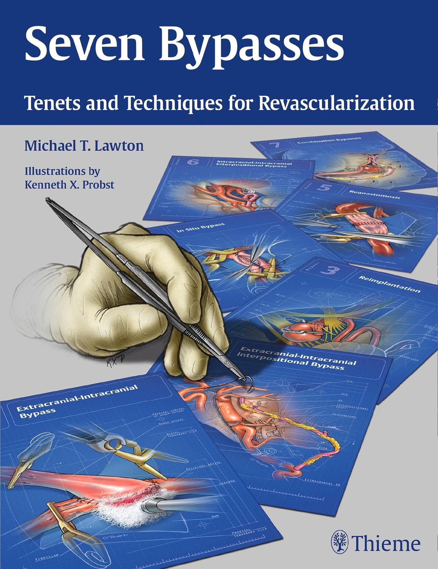 Seven Bypasses: Tenets and Techniques for Revascularization,Used