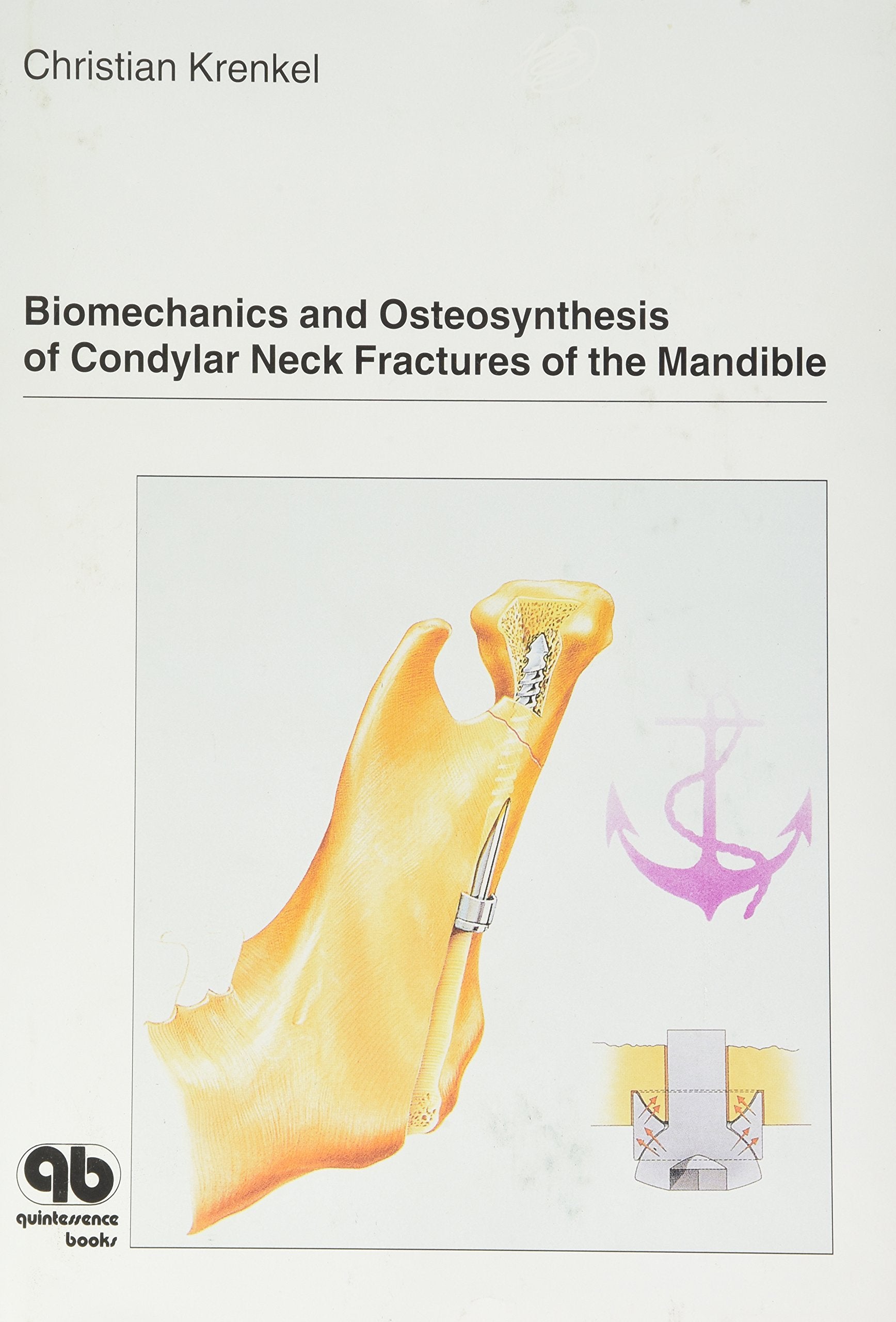 Biomechanics and Osteosynthesis of Condylar Neck Fractures of the Mandible,Used
