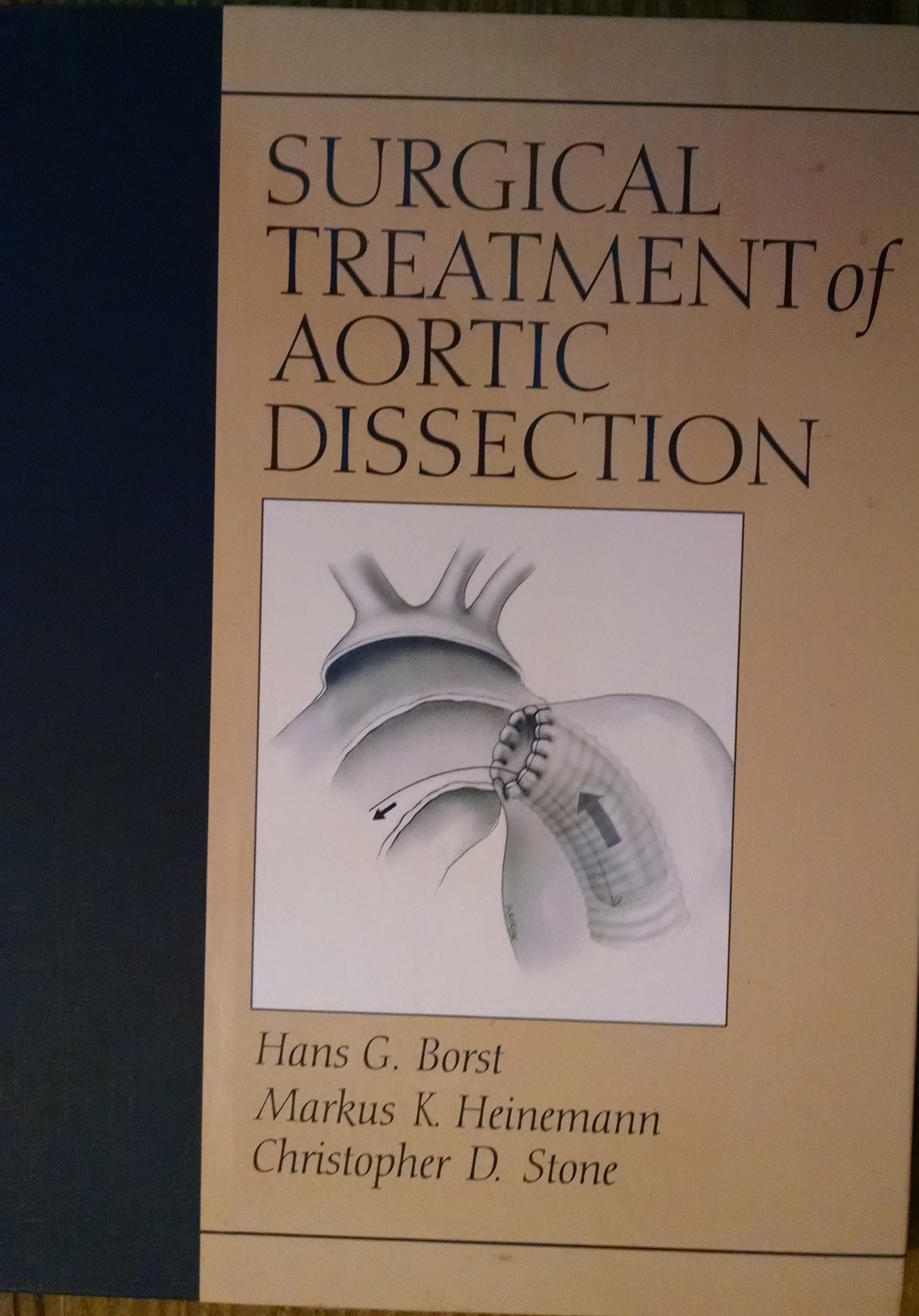 Surgical Treatment of Aortic Dissection,Used