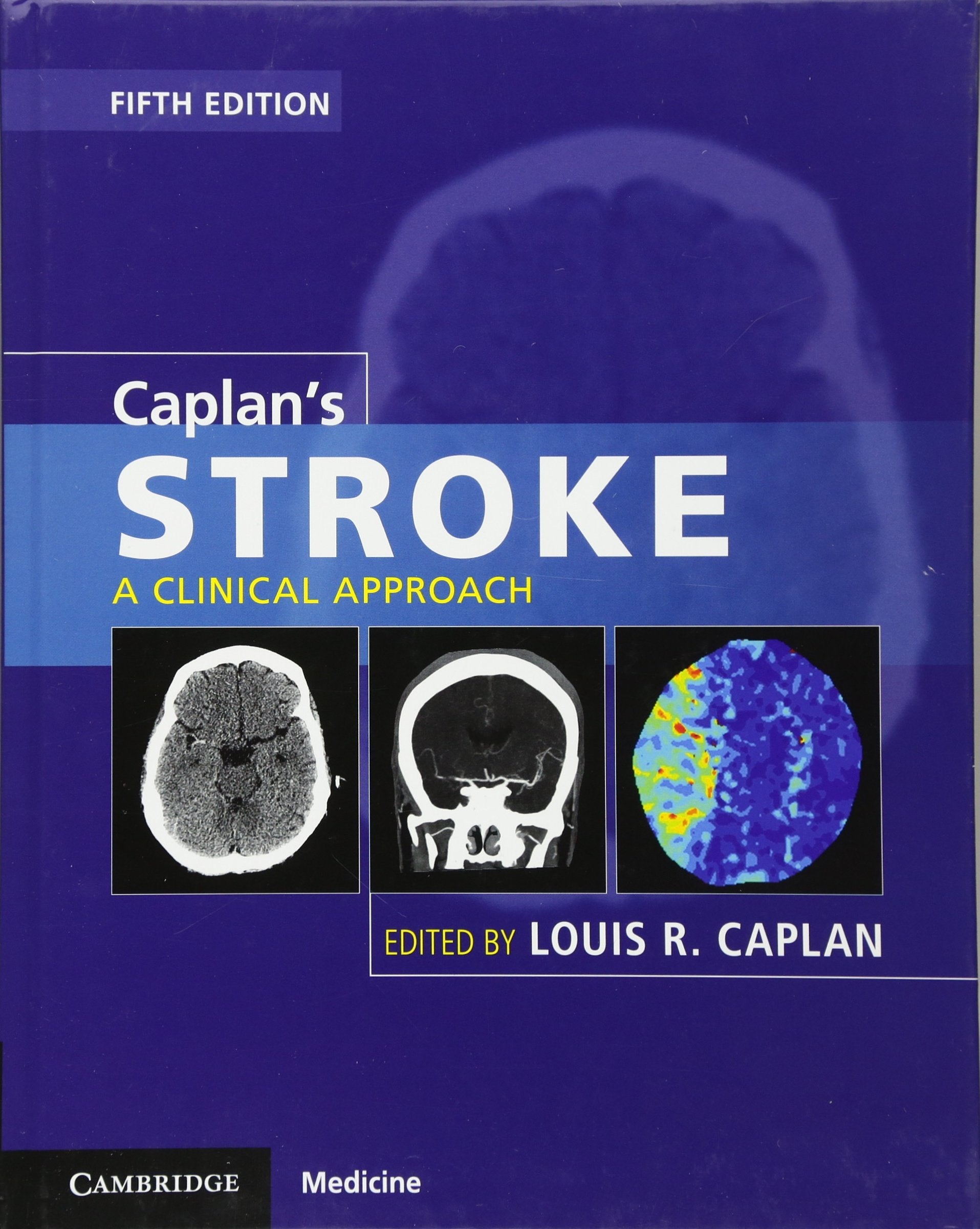 Caplan'S Stroke: A Clinical Approach
