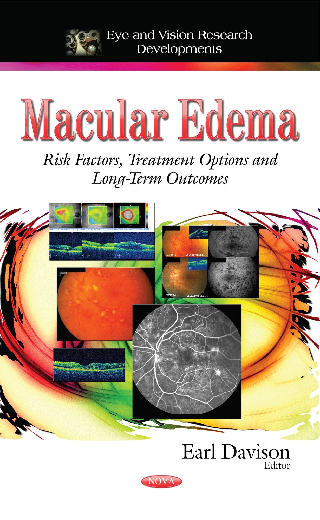 Macular Edema: Risk Factors, Treatment Options and LongTerm Outcomes (Eye and Vision Research Developments),Used
