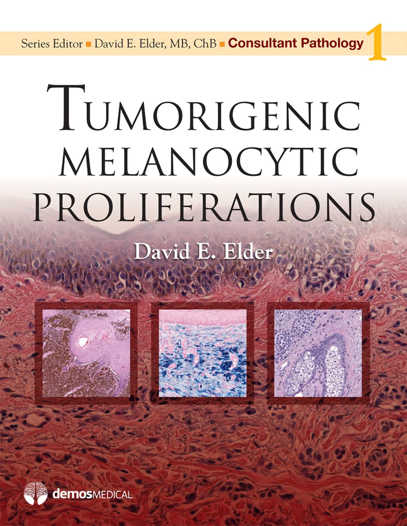 Consultant Pathology: Tumorigenic Melanocytic Proliferations,Used
