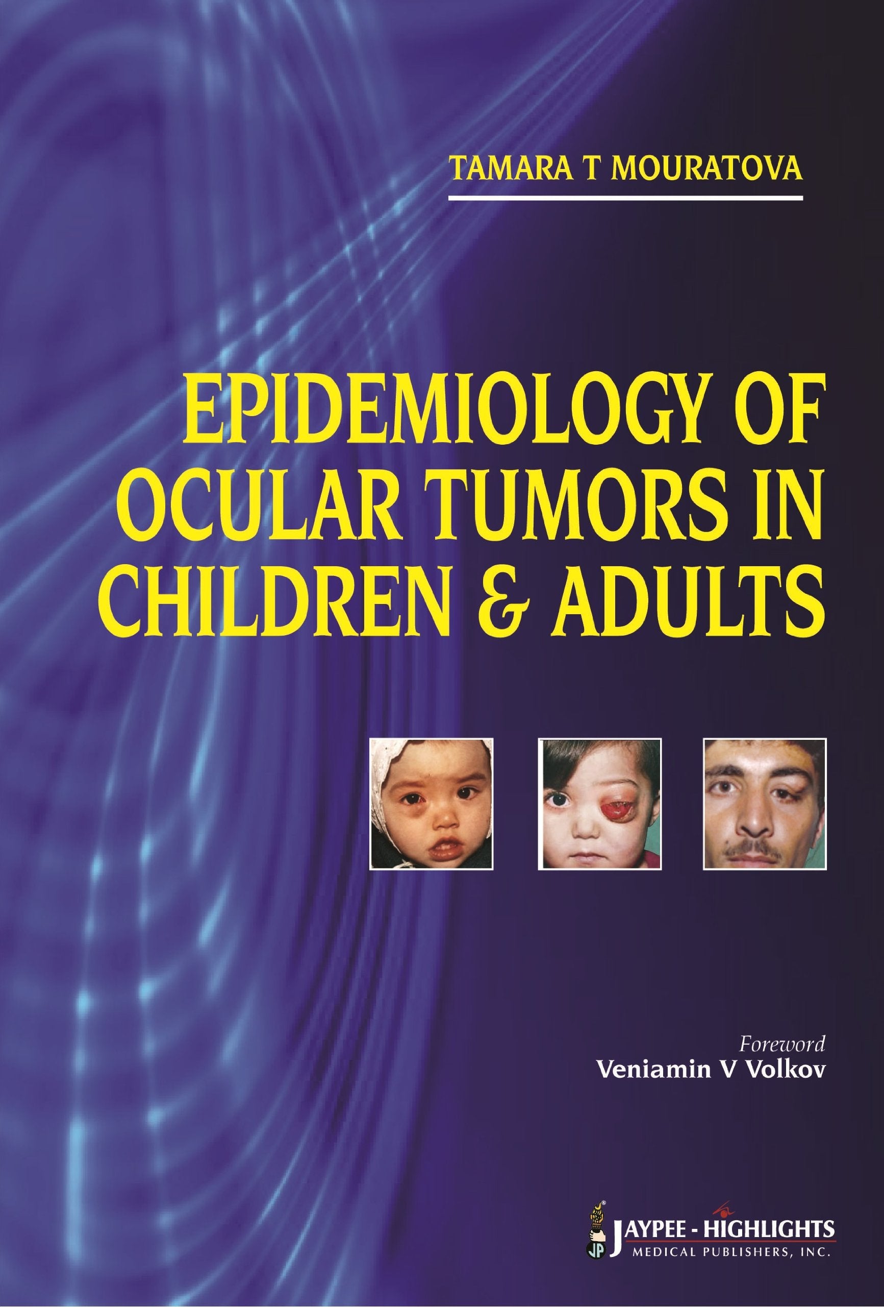 Epidemiology Of Ocular Tumors In Children And Adults,Used