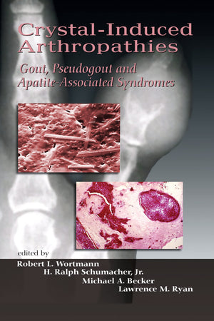 Crystalinduced Arthropathies,Used