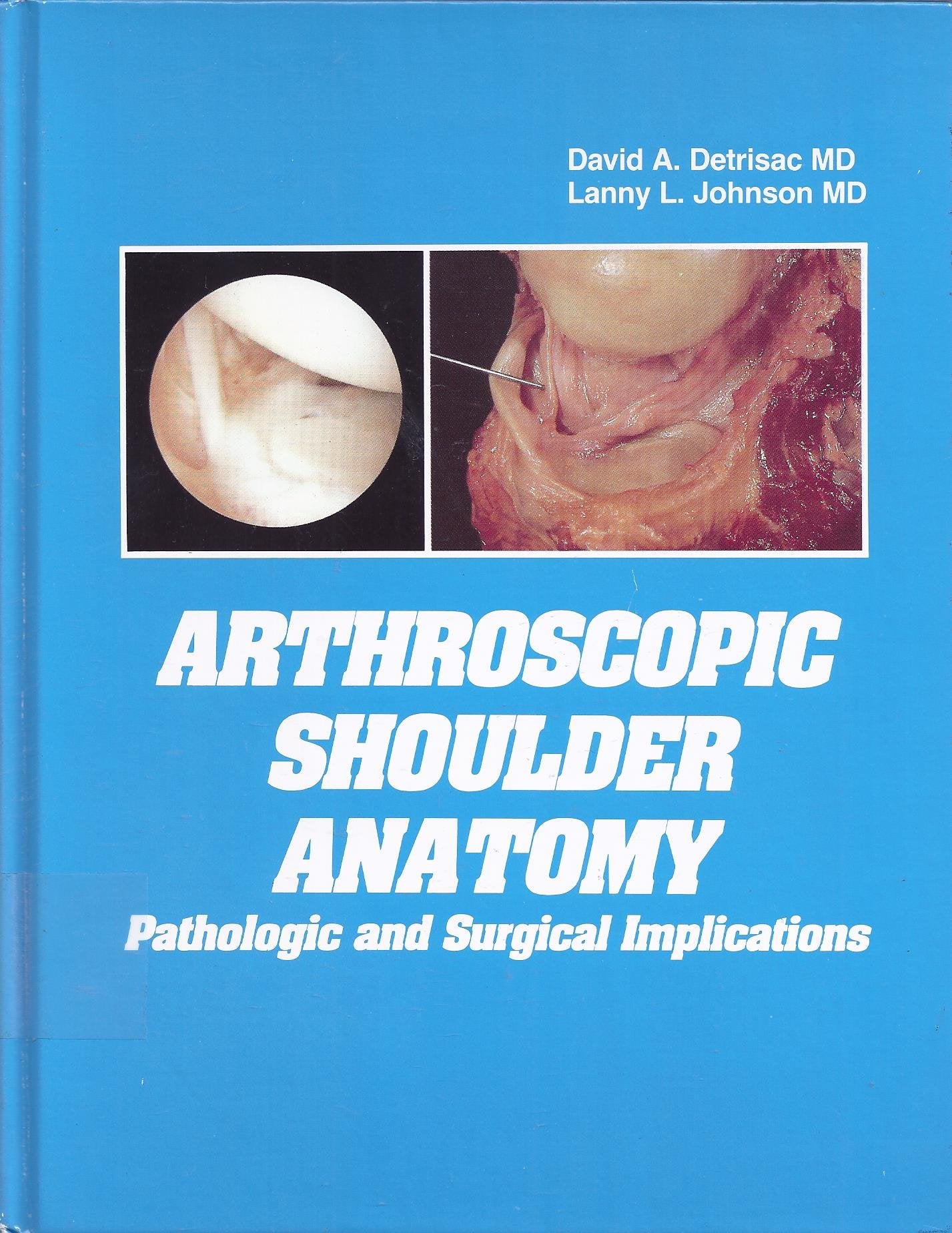 Arthroscopic Shoulder Anatomy: Pathologic and Surgical Implications,New