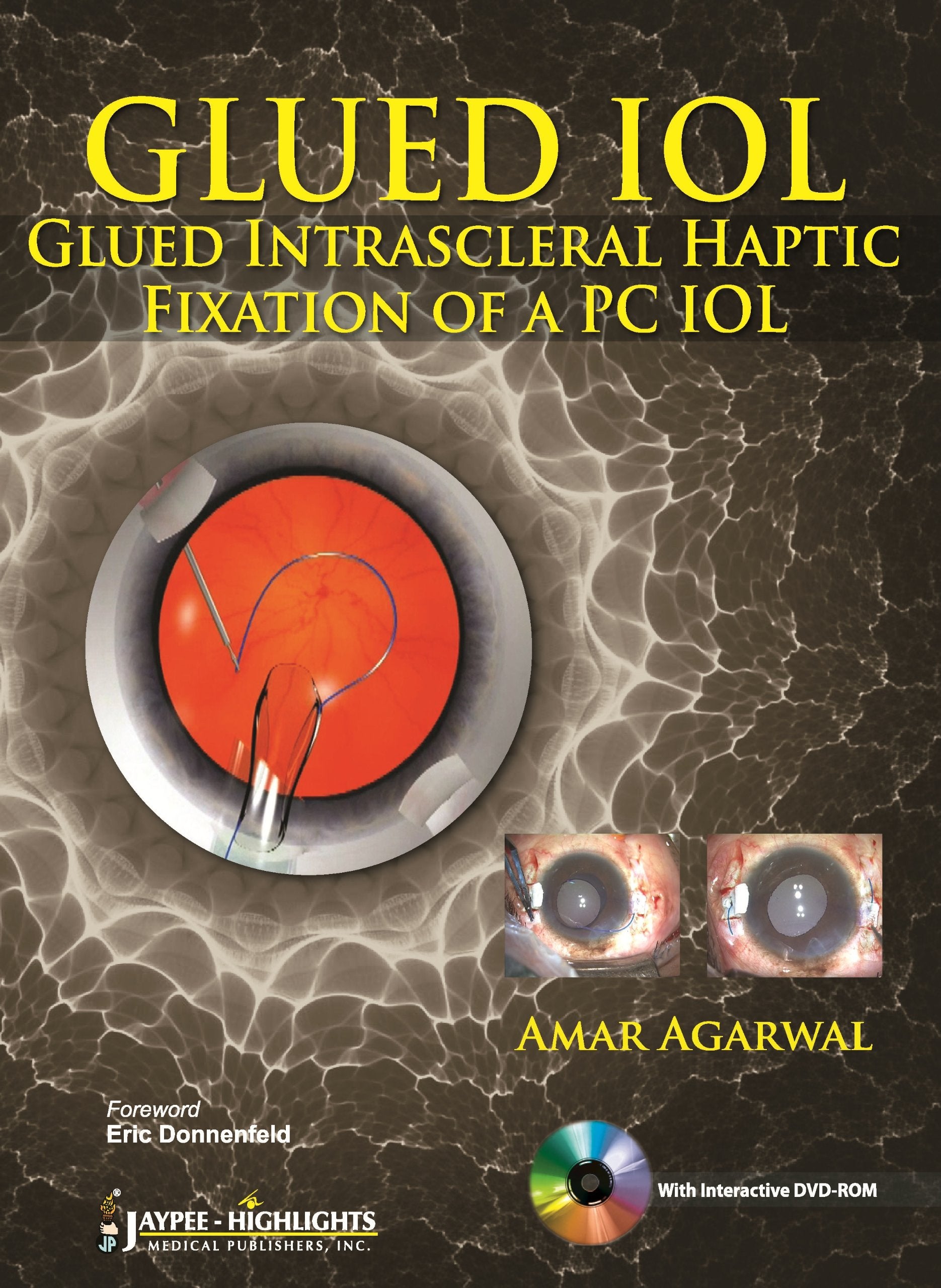 Glued Iol: Glued Intrascleral Haptic Fixation Of A Pc Iol,Used