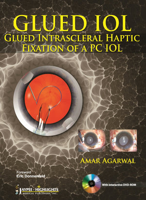 Glued Iol: Glued Intrascleral Haptic Fixation Of A Pc Iol,Used