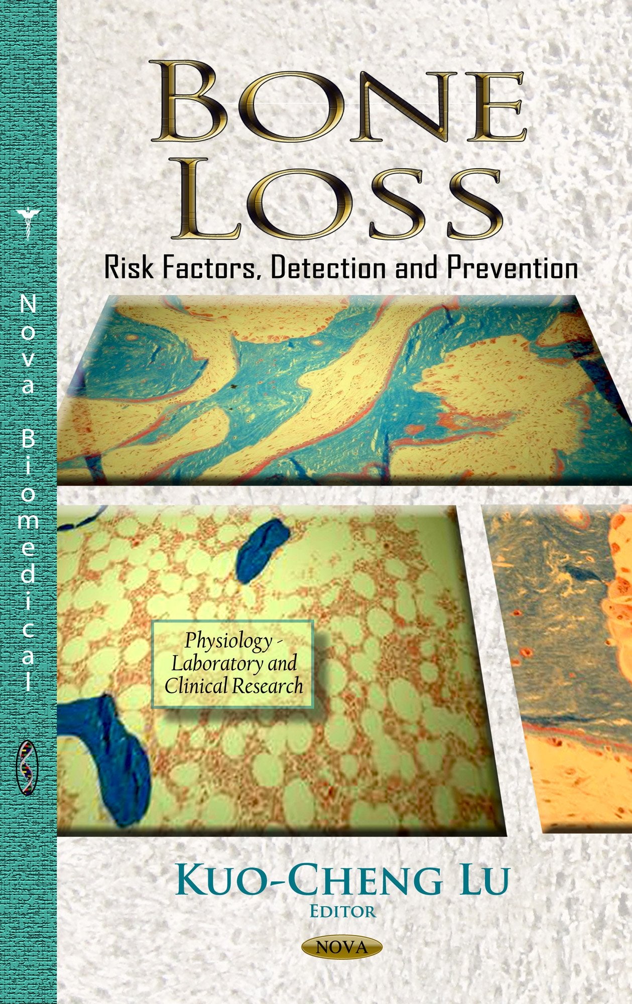 Bone Loss: Risk Factors, Detection and Prevention (Physiology  Laboratory and Clinical Research),Used