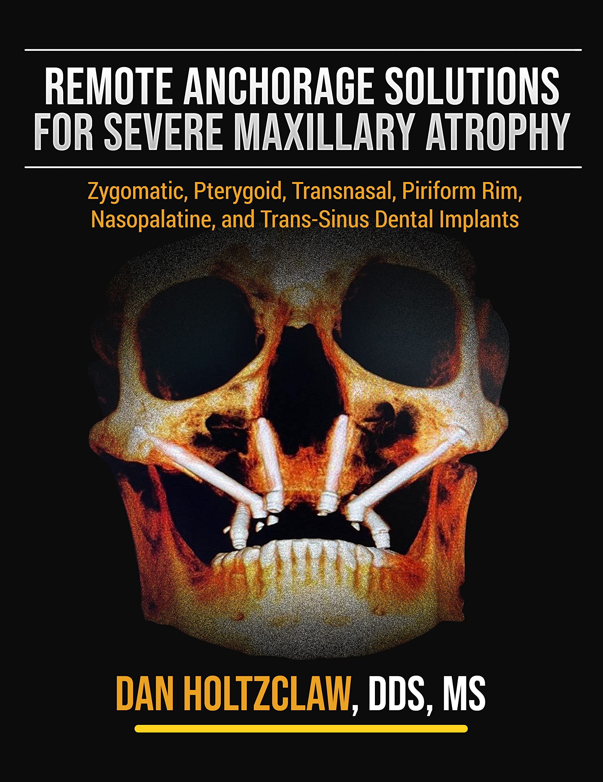 Remote Anchorage Solutions for Severe Maxillary Atrophy: Zygomatic Implants, Pterygoid Implants, Transnasal Implants, Piriform R