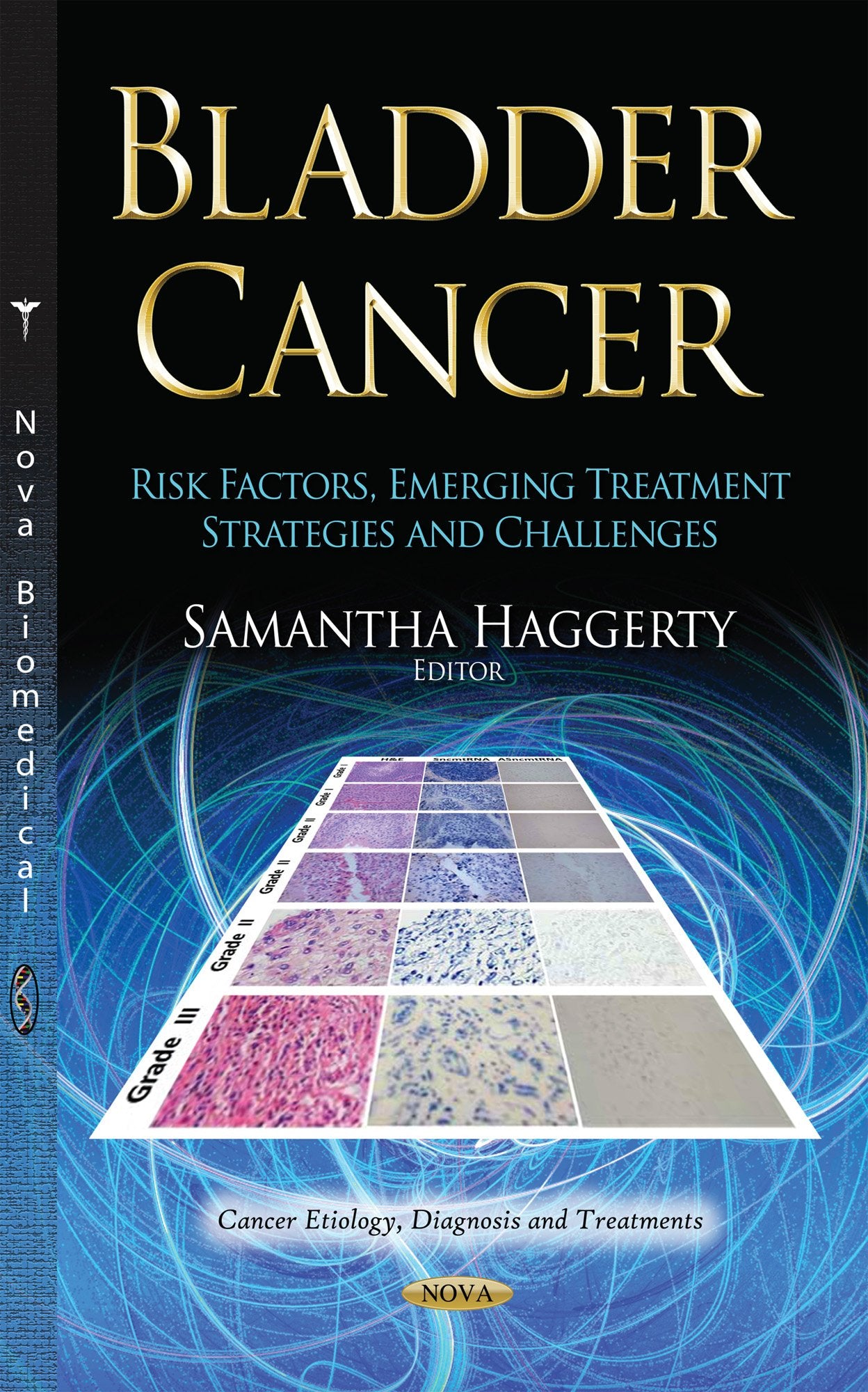 Bladder Cancer: Risk Factors, Emerging Treatment Strategies and Challenges,Used