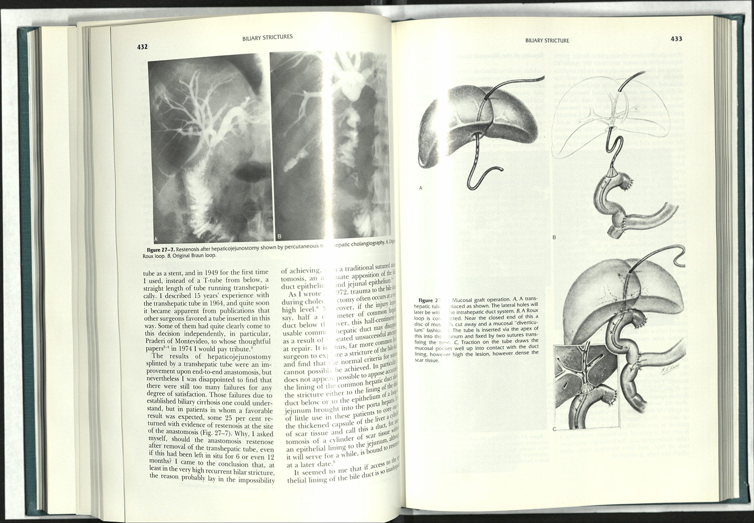 Surgery of the Gallbladder and Bile Ducts,Used