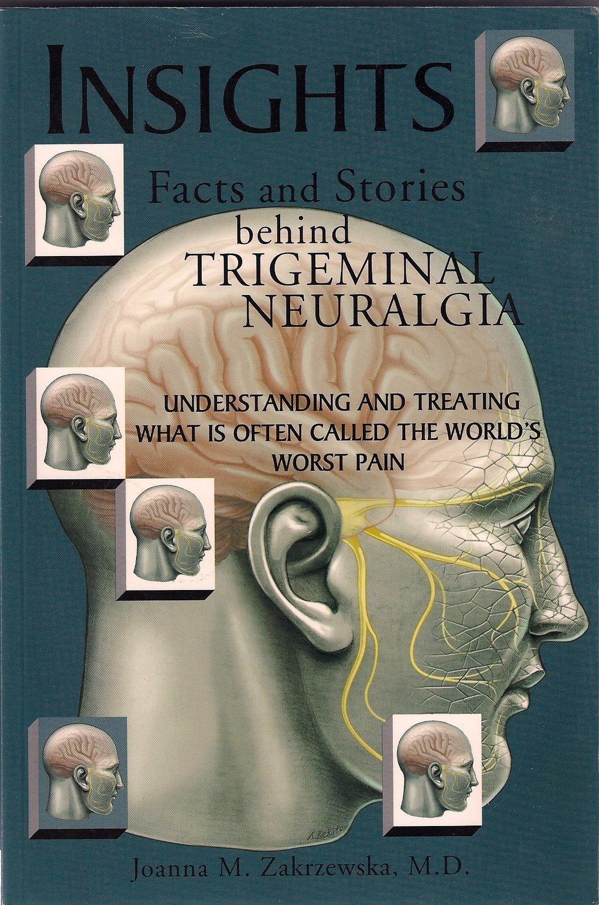 Insights Facts and Stories behind Trigeminal Neuralgia,Used