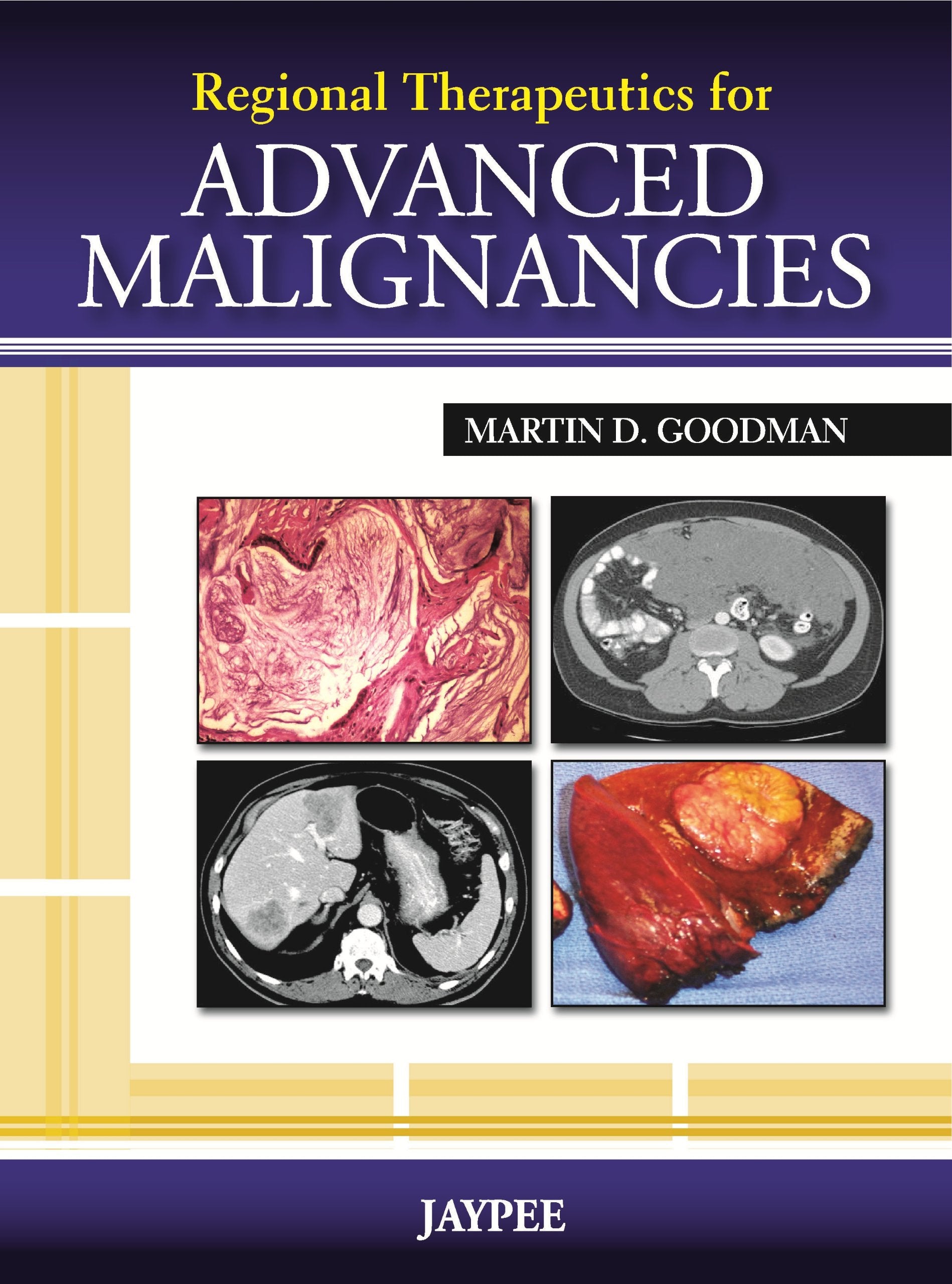 Regional Therapeutics for Advanced Malignancies,Used