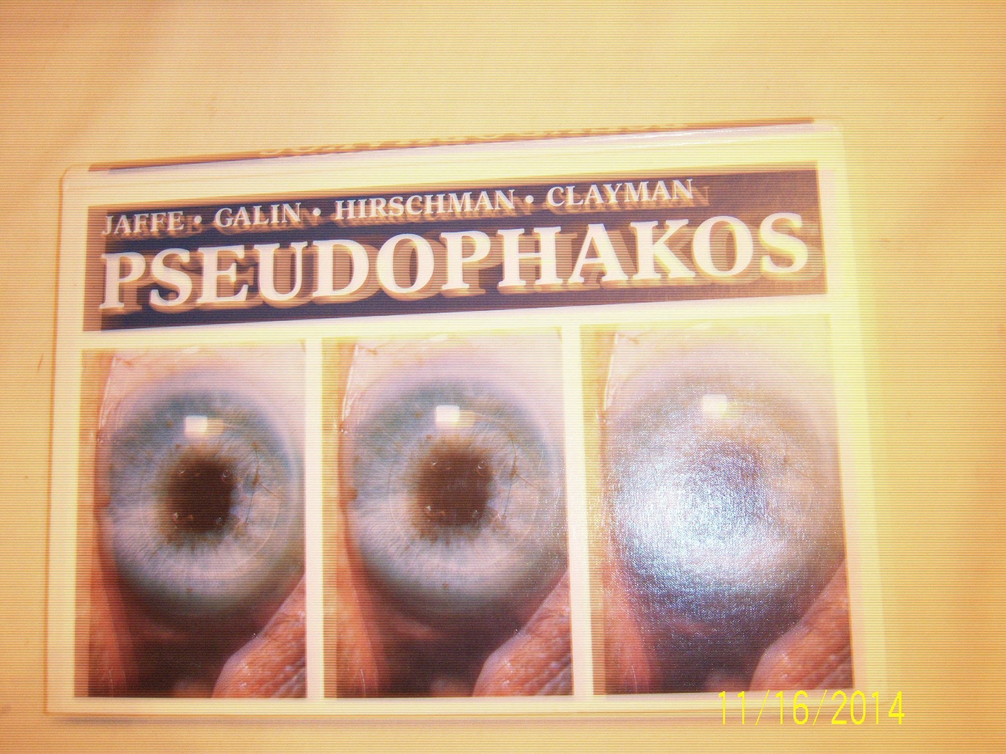 Pseudophakos,Used