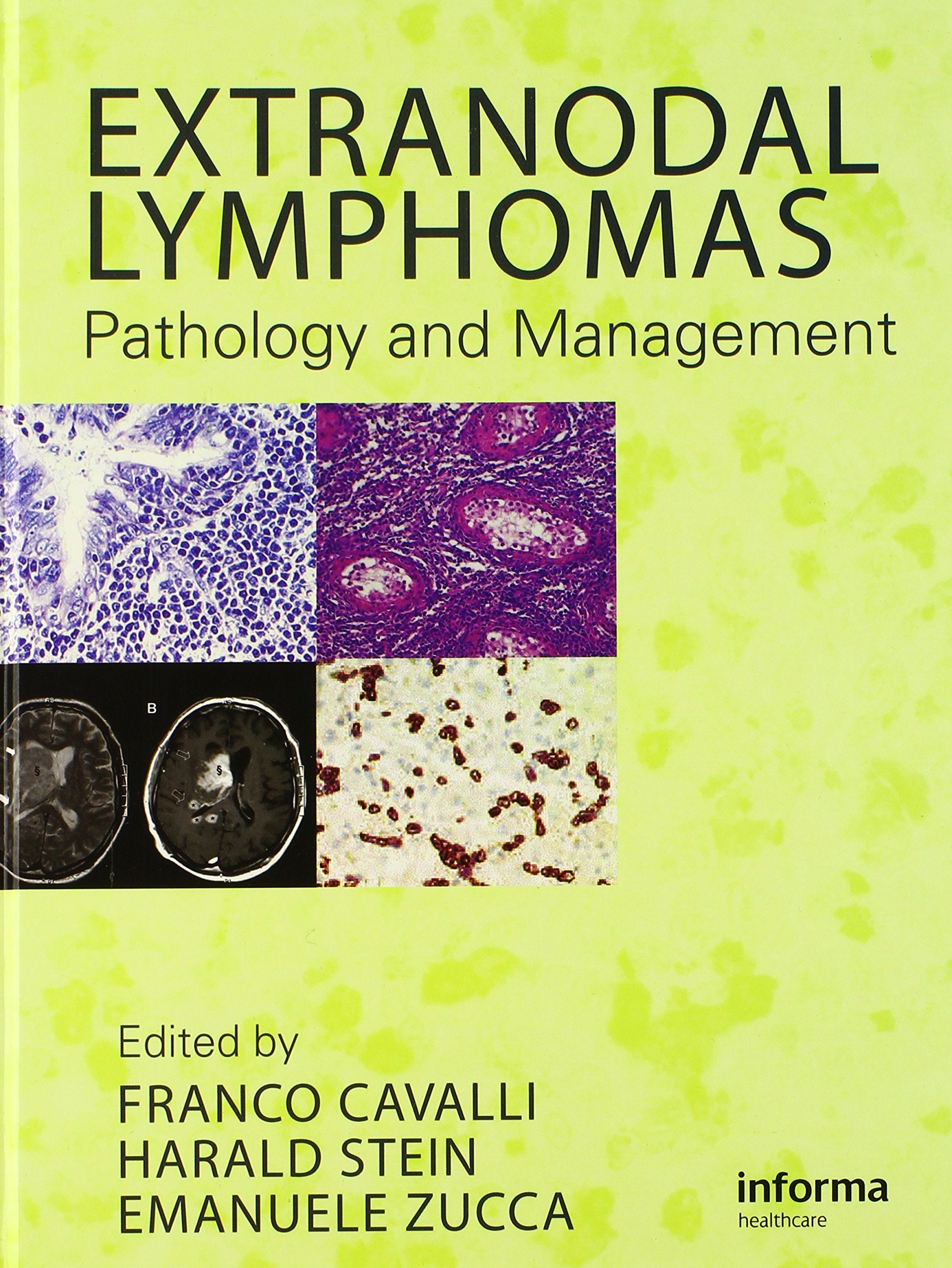 Extranodal Lymphomas: Pathology And Management